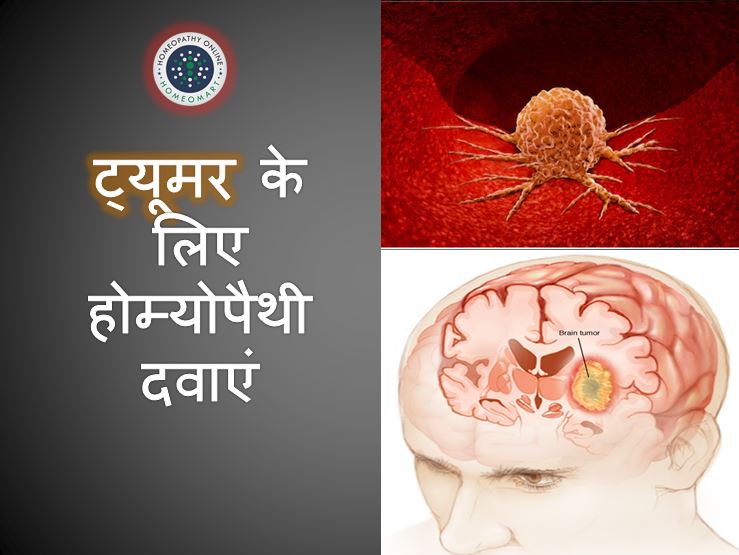 Brain Tumor homeopathic medicines in Hindi